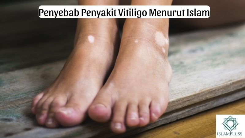 Penyebab Penyakit Vitiligo Menurut Islam