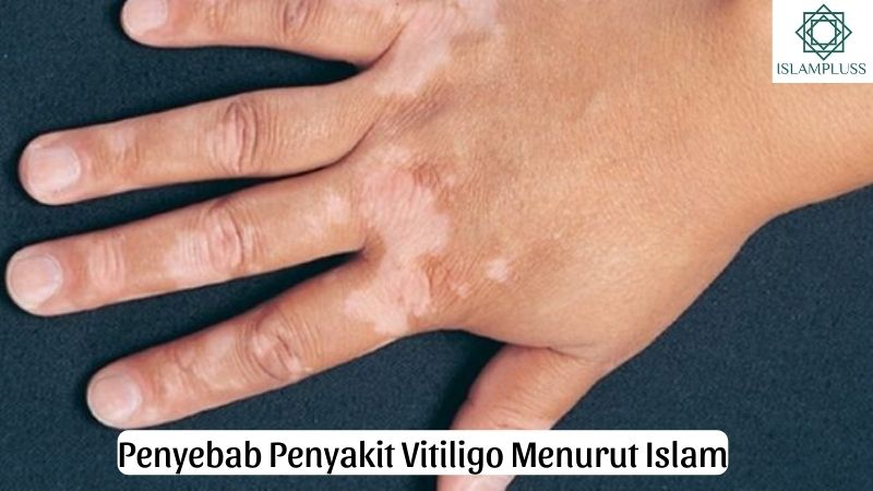 Penyebab Penyakit Vitiligo Menurut Islam